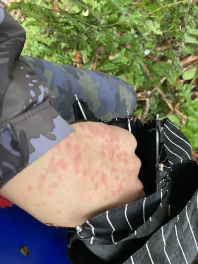 白蛉叮咬照片(新竹林區管理處提供)